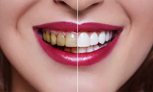 Professional Teeth Whitening in Sikar